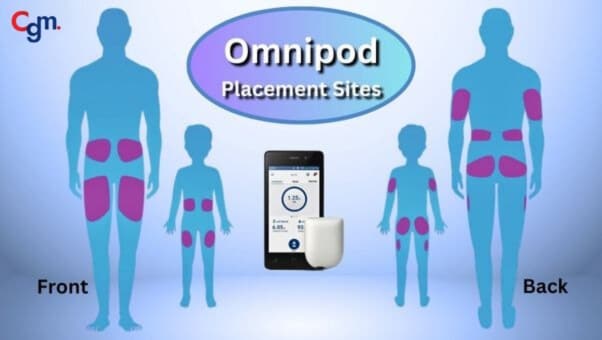 Omnipod Placement Sites