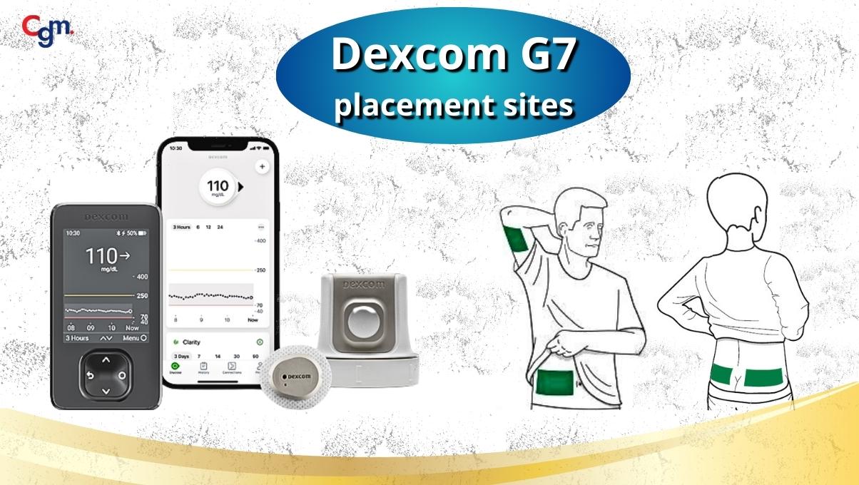 Dexcom G7 placement sites