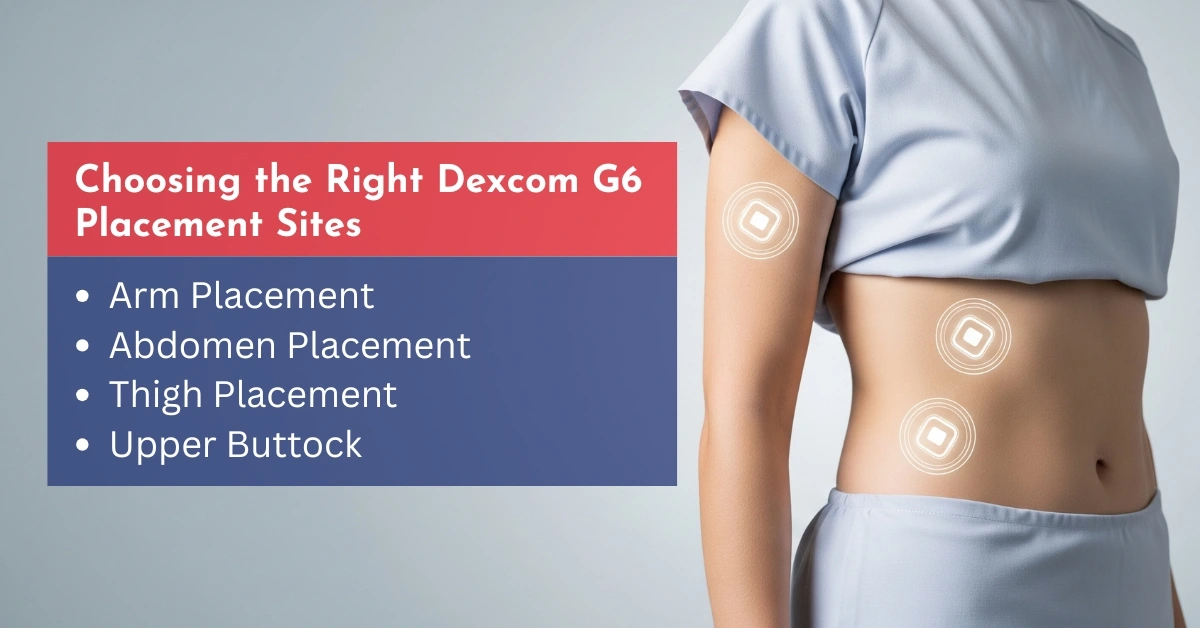 Choosing the Right Dexcom G6 Placement Sites