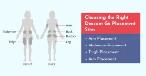 Choosing the right Dexcom G6 placement Sites