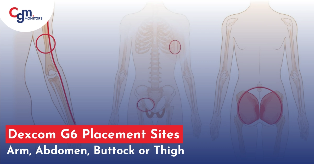 Dexcom G6 Placement sites