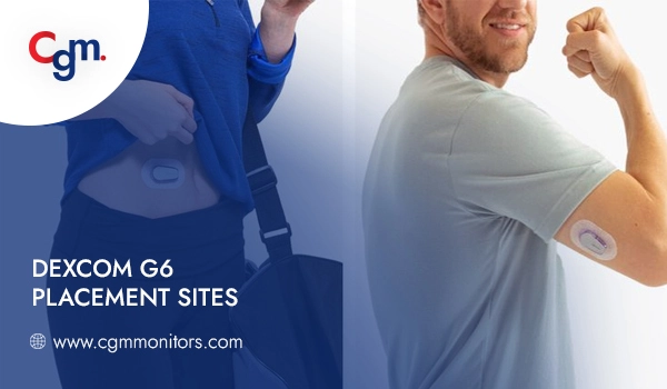Dexcom G6 Placement sites