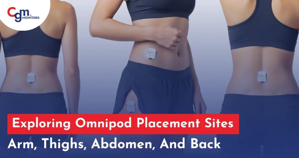 Exploring Omnipod Placement Sites