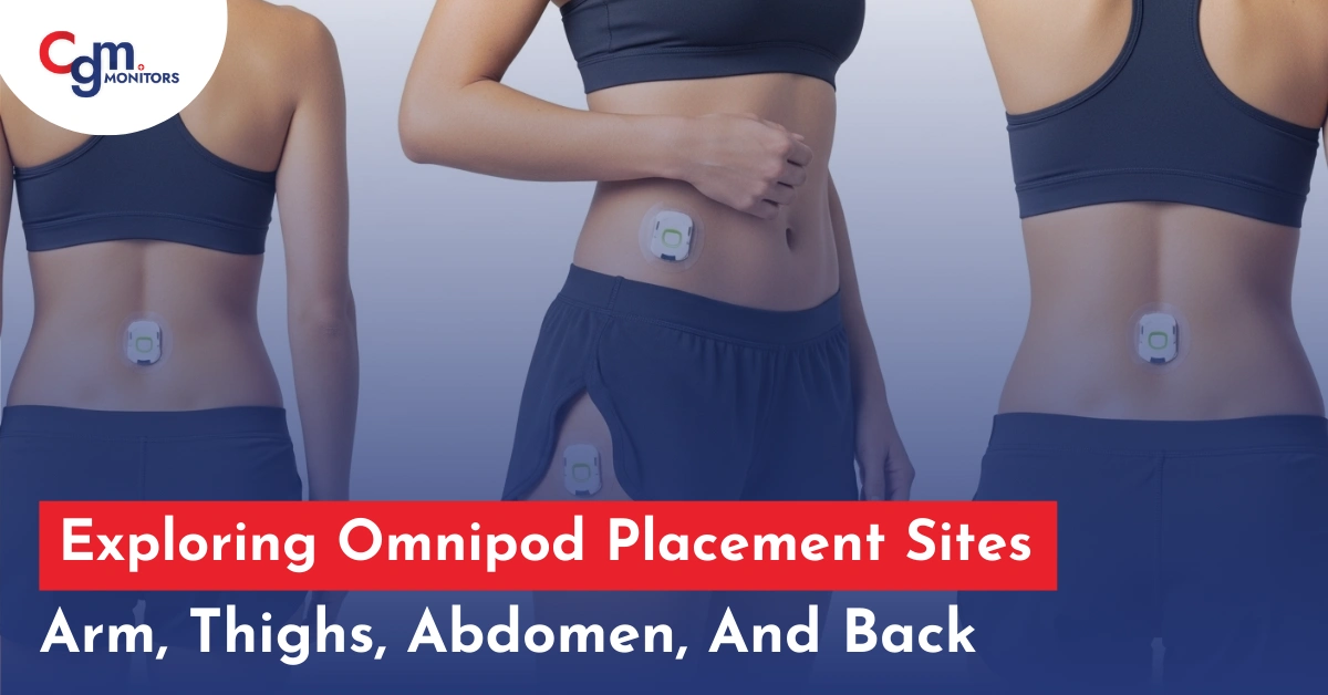 Exploring Omnipod Placement Sites