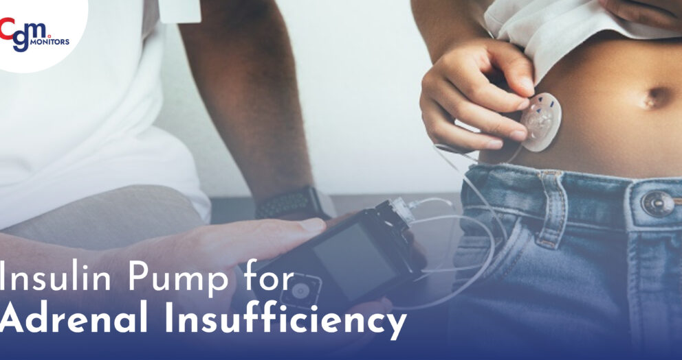 Insulin Pump for Adrenal Insufficiency