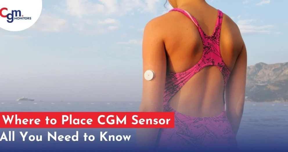 Where to Place CGM Sensor