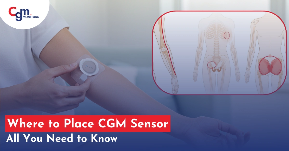 Where to Place CGM Sensor