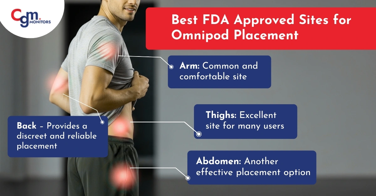 Best FDA Approved Sites for Omnipod Placement