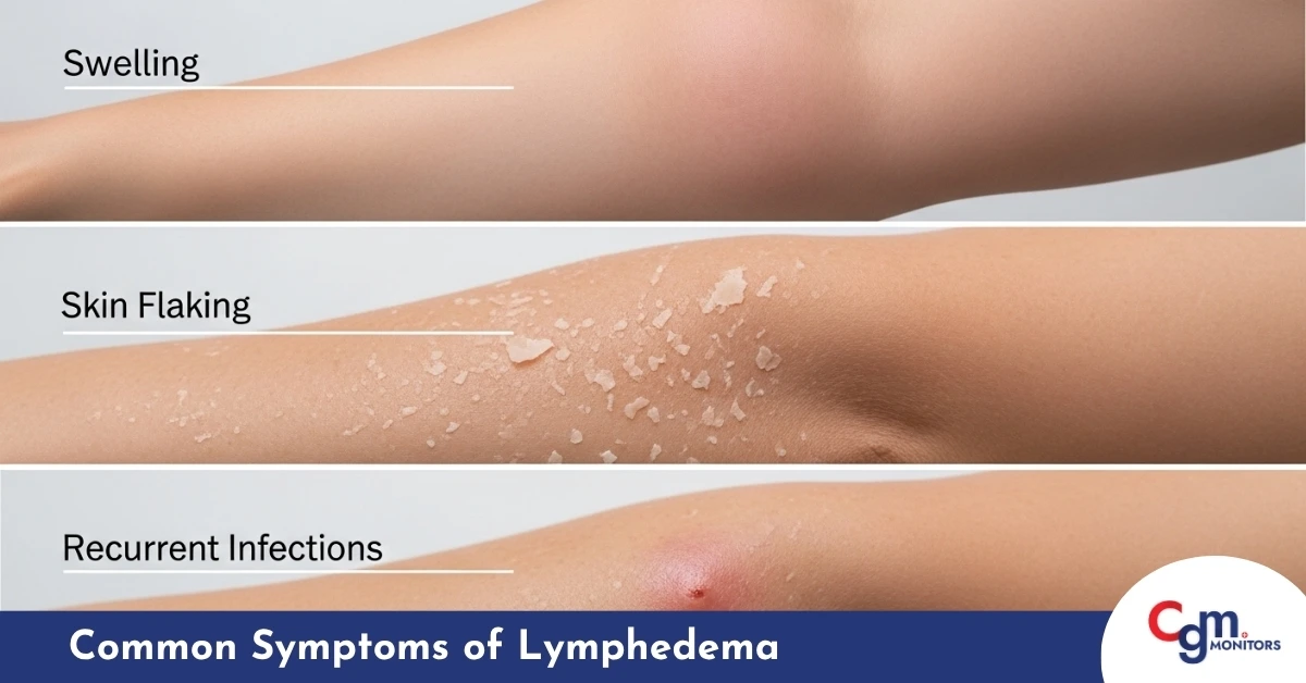 Common Symptoms of Lymphedema