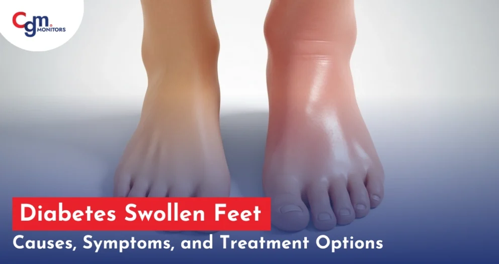 Diabetes Swollen Feet