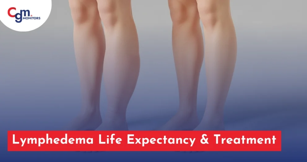 Lymphedema Life Expectancy
