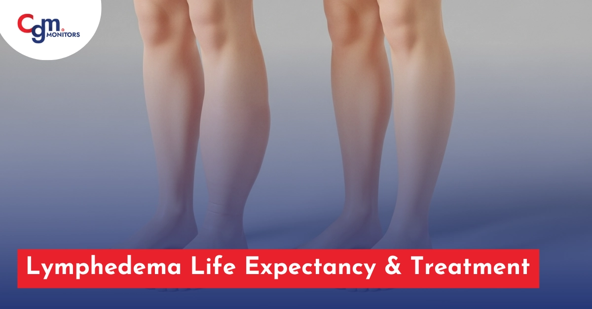 Lymphedema Life Expectancy