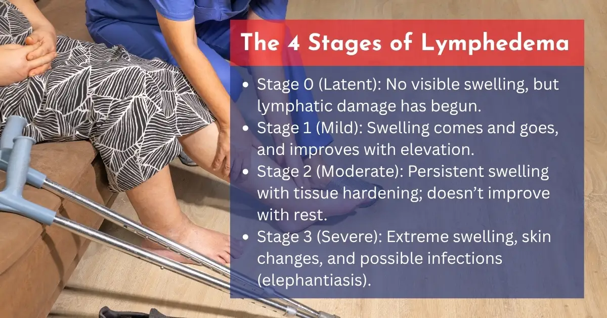 4 Stages of Lymphedema