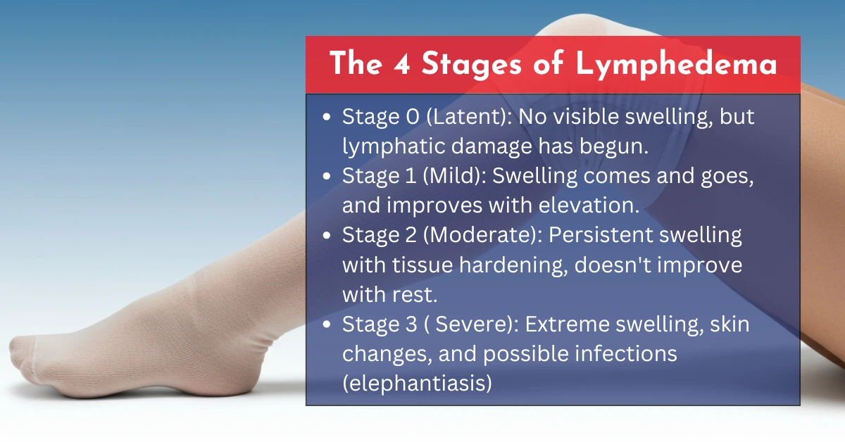 4 stages of Lymphedema