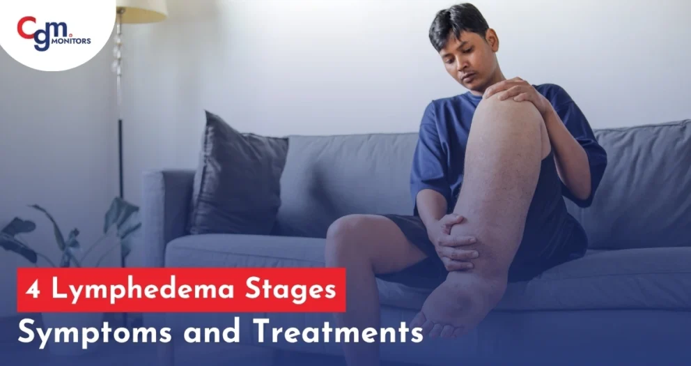 lymphedema stages