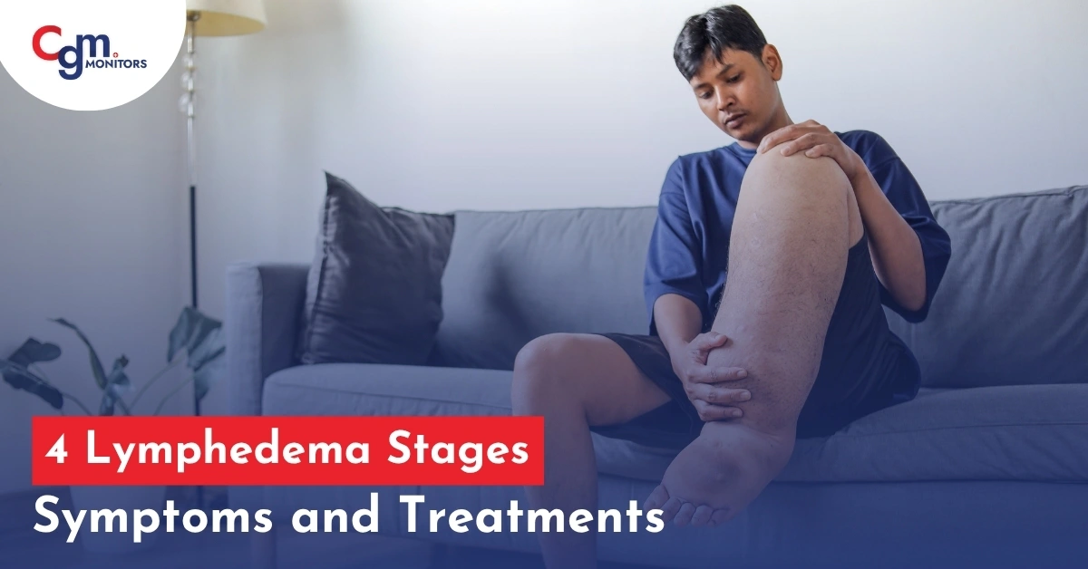lymphedema stages