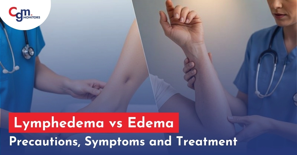 Lymphedema vs Edema