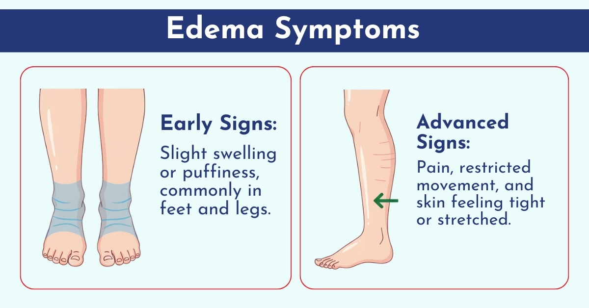 Symptoms of Edema