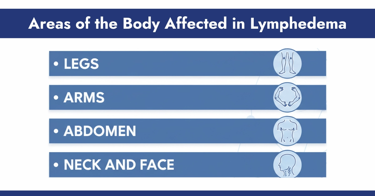 Areas of the Body Affected in Lymphedema