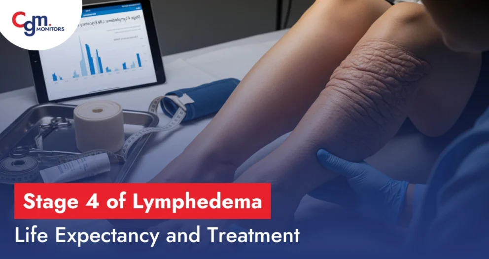 Stage 4 of Lymphedema